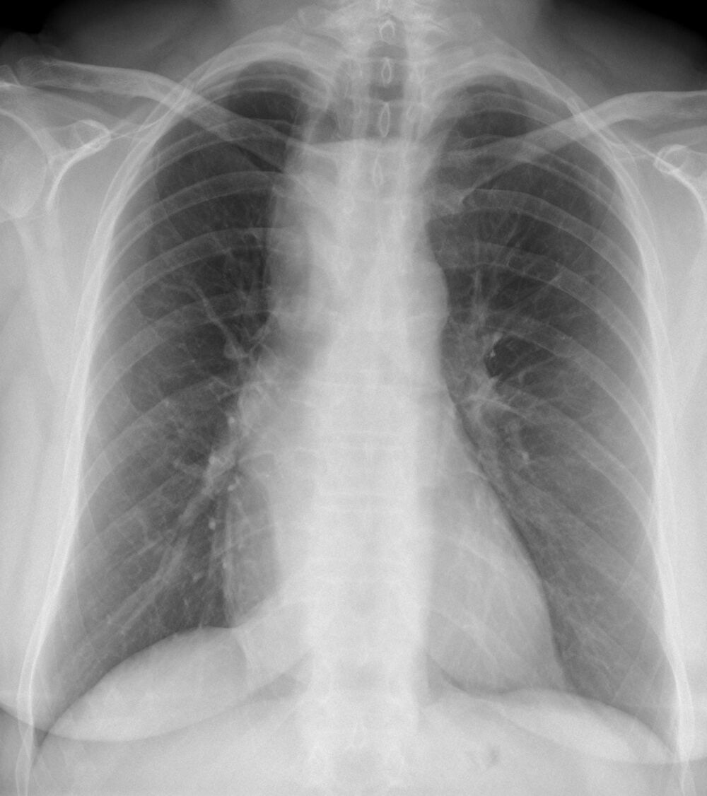 Radiografía de tórax vista en un visor